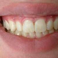 L�ckenschluss nach Kfo